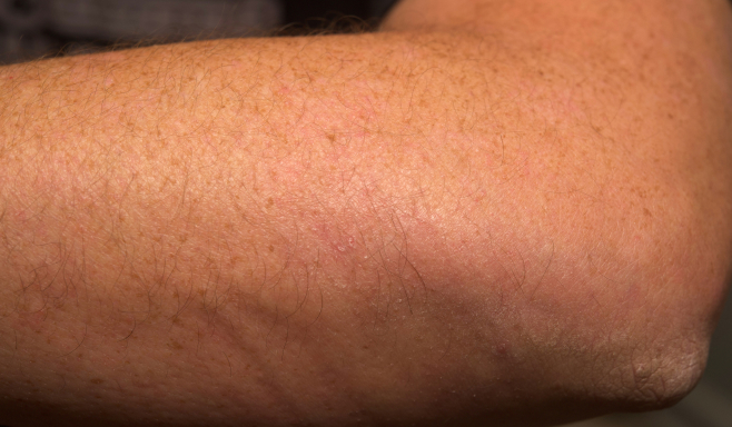 Real patient picture of the arms of a moderate to severe plaque psoriasis patient after 24 weeks of taking SOTYKTU®.