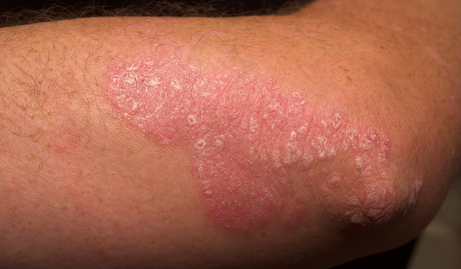 Real patient picture of moderate to severe plaque psoriasis on arms on day 0 of SOTYKTU®.