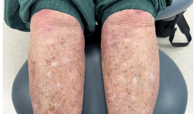 Real patient picture of the legs of a moderate to severe plaque psoriasis patient after 24 weeks of taking SOTYKTU®.