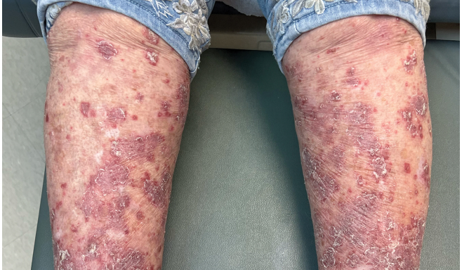 Real patient picture of moderate to severe plaque psoriasis on legs on day 0 of SOTYKTU®.