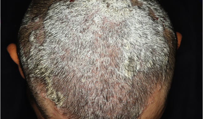 Real patient picture of moderate to severe plaque psoriasis on scalp on day 0 of SOTYKTU®.